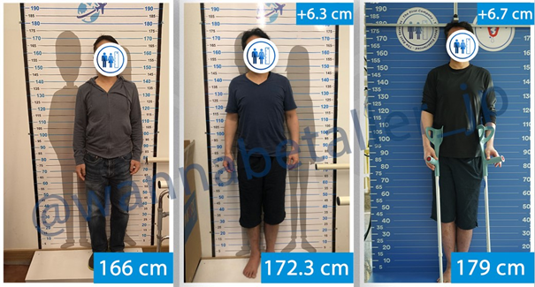 Témoignages allongement des jambes – Patients avant et après la chirurgie montrant des résultats visibles.