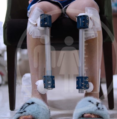 Témoignages allongement des jambes – Patients avant et après la chirurgie montrant des résultats visibles.