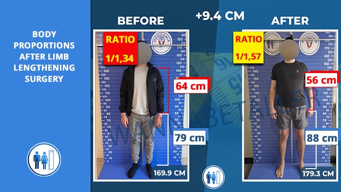 proportions après une chirurgie d’allongement des membres