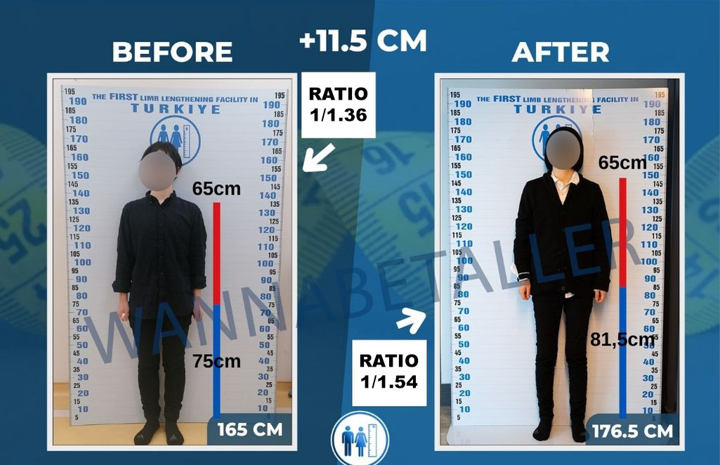 proportions après une chirurgie d’allongement des membres